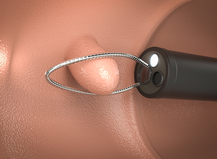 目指せ、大腸癌撲滅！そのために大腸カメラや便潜血検査を！